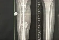 Adrian, who suffered a severe accident