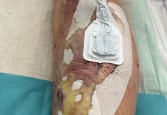 Adrian, who suffered a severe accident