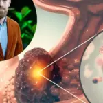 Stomach cancer is increasingly diagnosed in younger people: what's going on here?