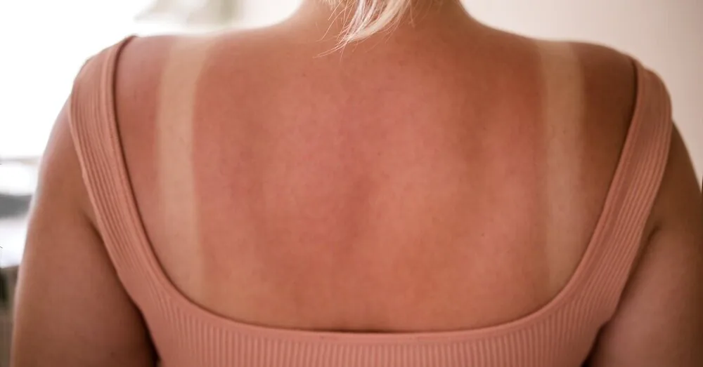 I thought I had a sunburn, but it turned out to be something else entirely: these symptoms may indicate a more serious problem