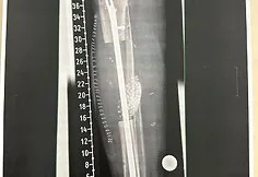 Adrian, who suffered a severe accident