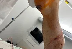 Adrian, who suffered a severe accident