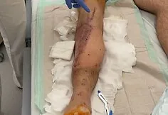 Adrian, who suffered a severe accident