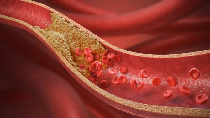 Shutterstock photo/Cholesterol