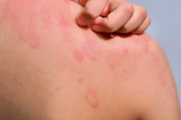 A woman is allergic to almost everything – from food to air and even her own sofa, only one thing saves her from death