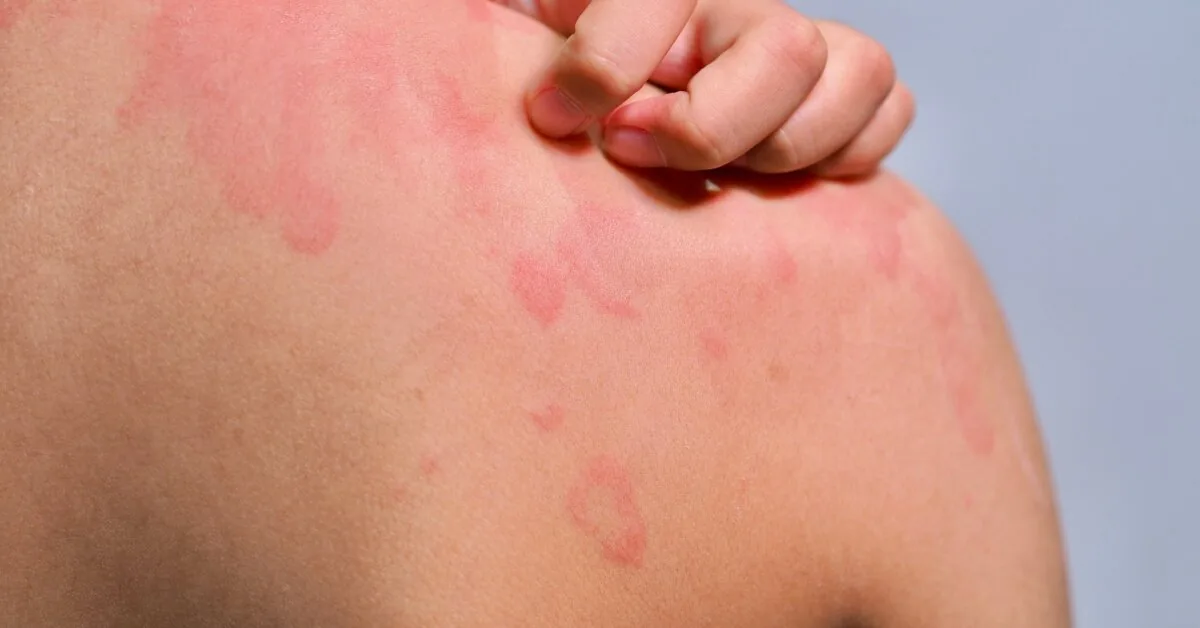 A woman is allergic to almost everything – from food to air and even her own sofa, only one thing saves her from death