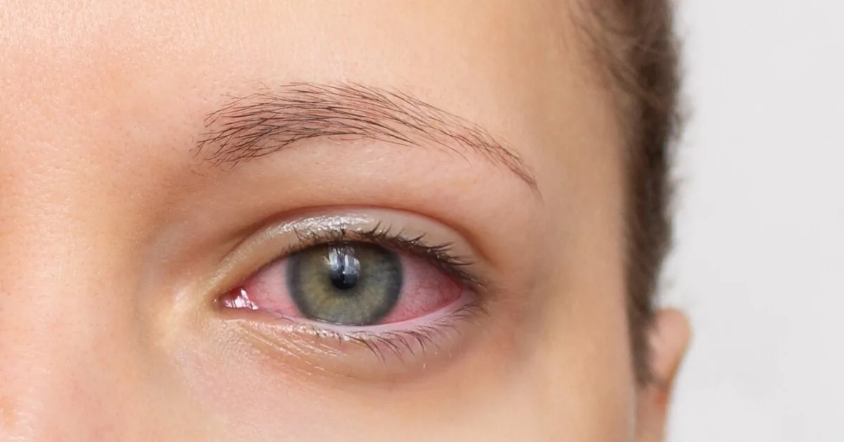 Dry, itchy, or watery eyes? The problem may lie in the eyelids