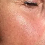 The legacy of sunbathing on the skin – wrinkles: is it possible to reverse the damage done in summer?