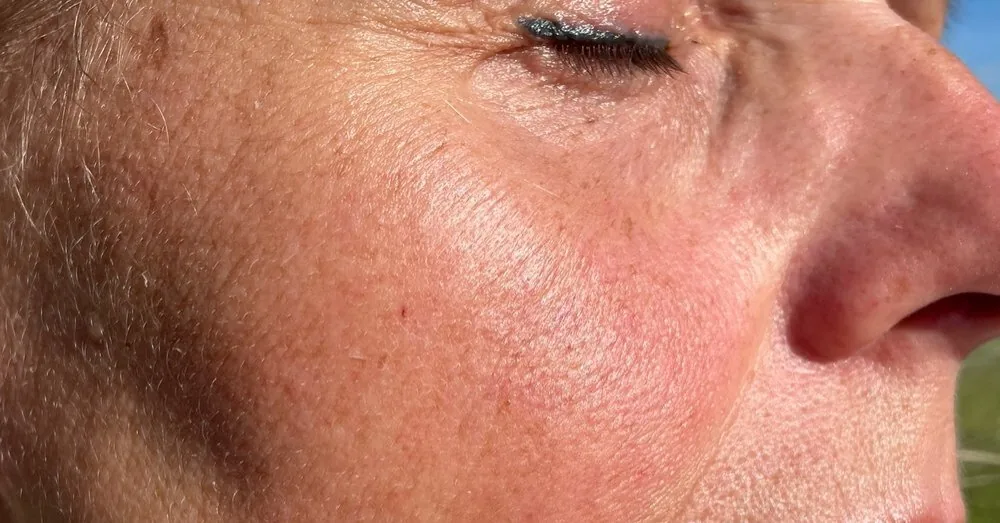 The legacy of sunbathing on the skin – wrinkles: is it possible to reverse the damage done in summer?