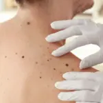 Doctors in Cesiai named dangerous skin changes: cannot be ignored, it can save a life