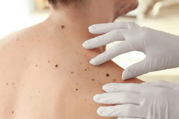 Doctors in Cesiai named dangerous skin changes: cannot be ignored, it can save a life
