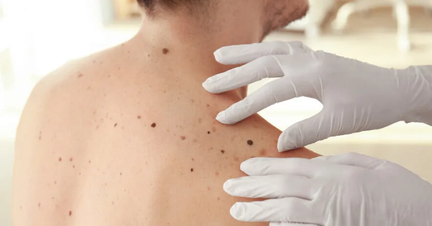 Doctors in Cesiai named dangerous skin changes: cannot be ignored, it can save a life