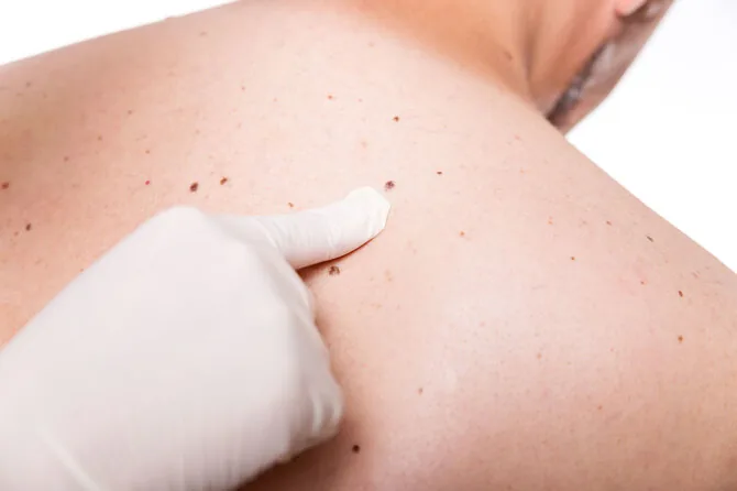 123RF.com photo/If you have more than 50 moles on your entire body, an annual dermatologist consultation is necessary