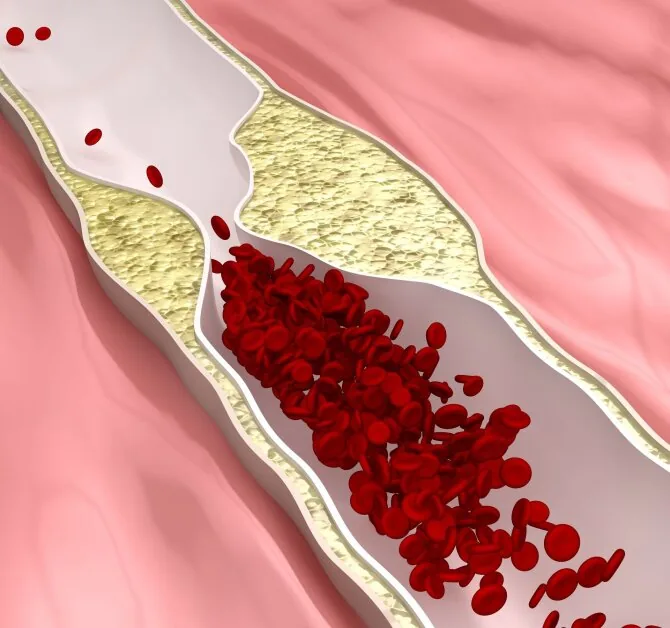123RF.com photo/Atherosclerosis