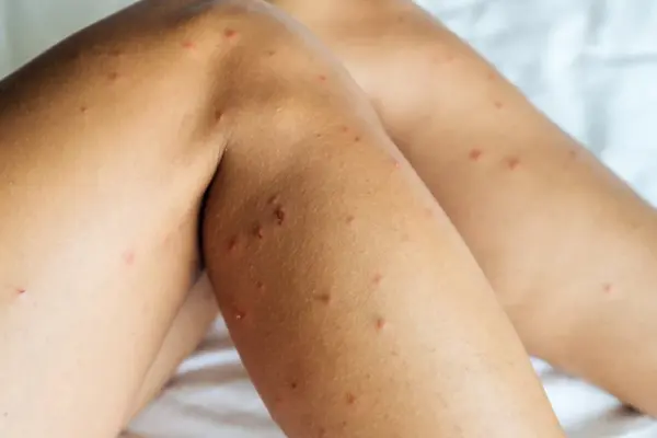 Mosquito, midge, or hornet? You can tell what bit you by these signs