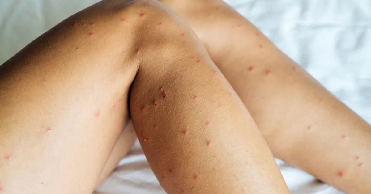 Mosquito, midge, or hornet? You can tell what bit you by these signs