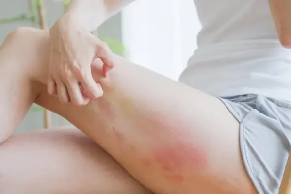 Is eczema contagious and why does it often recur in families?