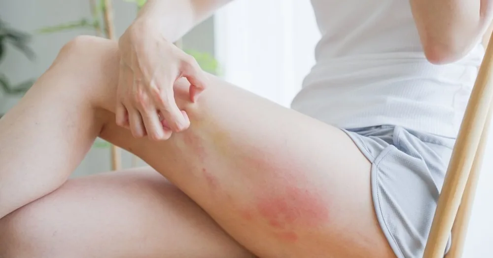 Is eczema contagious and why does it often recur in families?