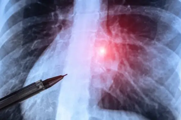Why does one smoker get cancer, and another does not? Finally, scientists have found the answer