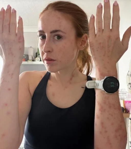 @thecapetownblog photo / The woman showed what happened to her body after a night in the hotel