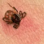 Less common than Lyme disease, but much more dangerous: doctors warn about tularemia