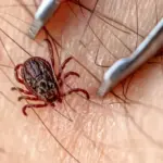Swede discovered a tick in an incredible place: even experienced doctors were puzzled about how to remove it