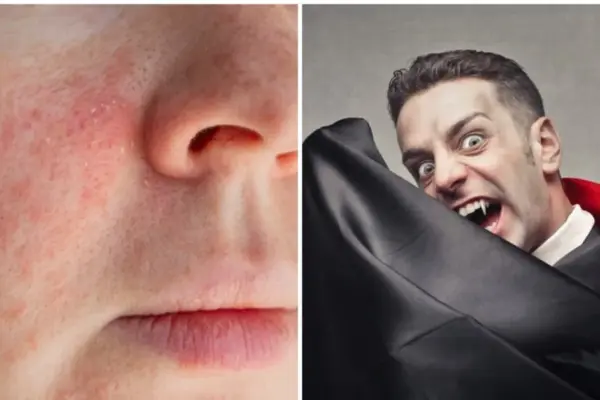 Sensitivity to light and red teeth: what is porphyria and why is it associated with vampires?