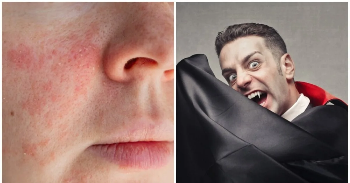 Sensitivity to light and red teeth: what is porphyria and why is it associated with vampires?