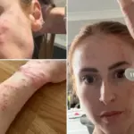 One night in an English hotel – 100 bites: a horrified woman showed what happened to her body