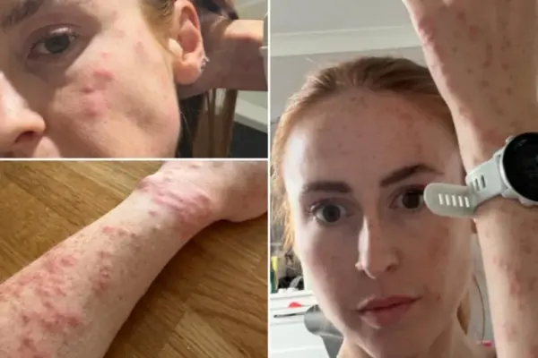 One night in an English hotel – 100 bites: a horrified woman showed what happened to her body