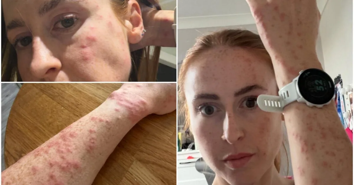 One night in an English hotel – 100 bites: a horrified woman showed what happened to her body