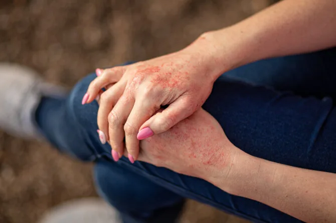 123RF.com nuotr./Dermatitas