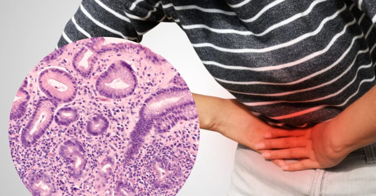 7 warning signs of H. pylori: check without delay