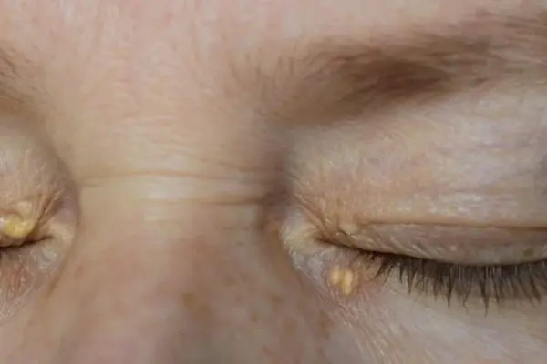 Look into your eyes – these signs may warn of high cholesterol