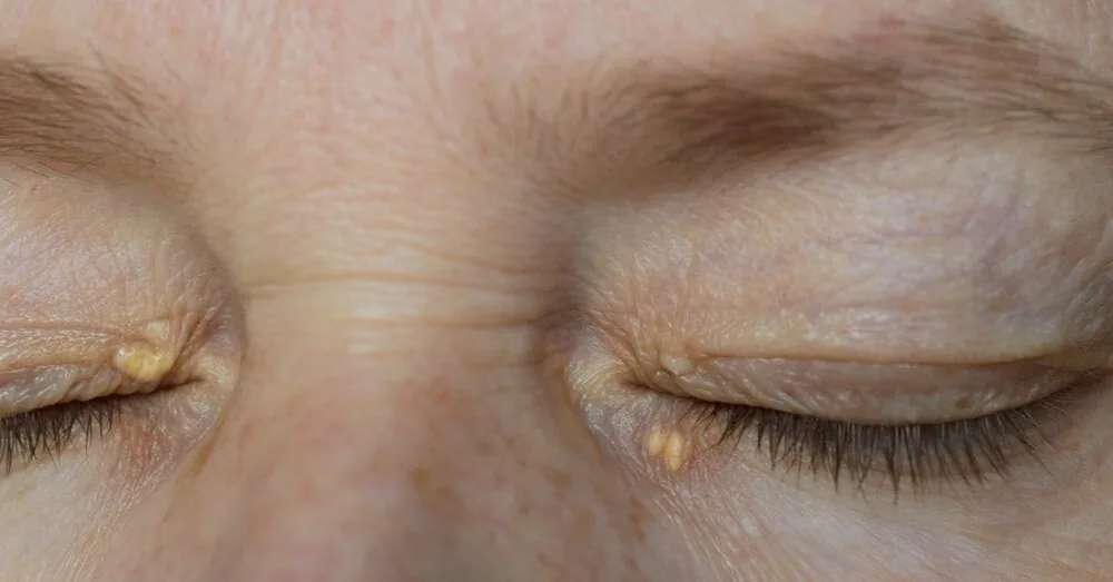 Look into your eyes – these signs may warn of high cholesterol