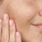 Summer left marks on the skin? They said what will help fight pigmentation spots