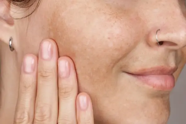 Summer left marks on the skin? They said what will help fight pigmentation spots