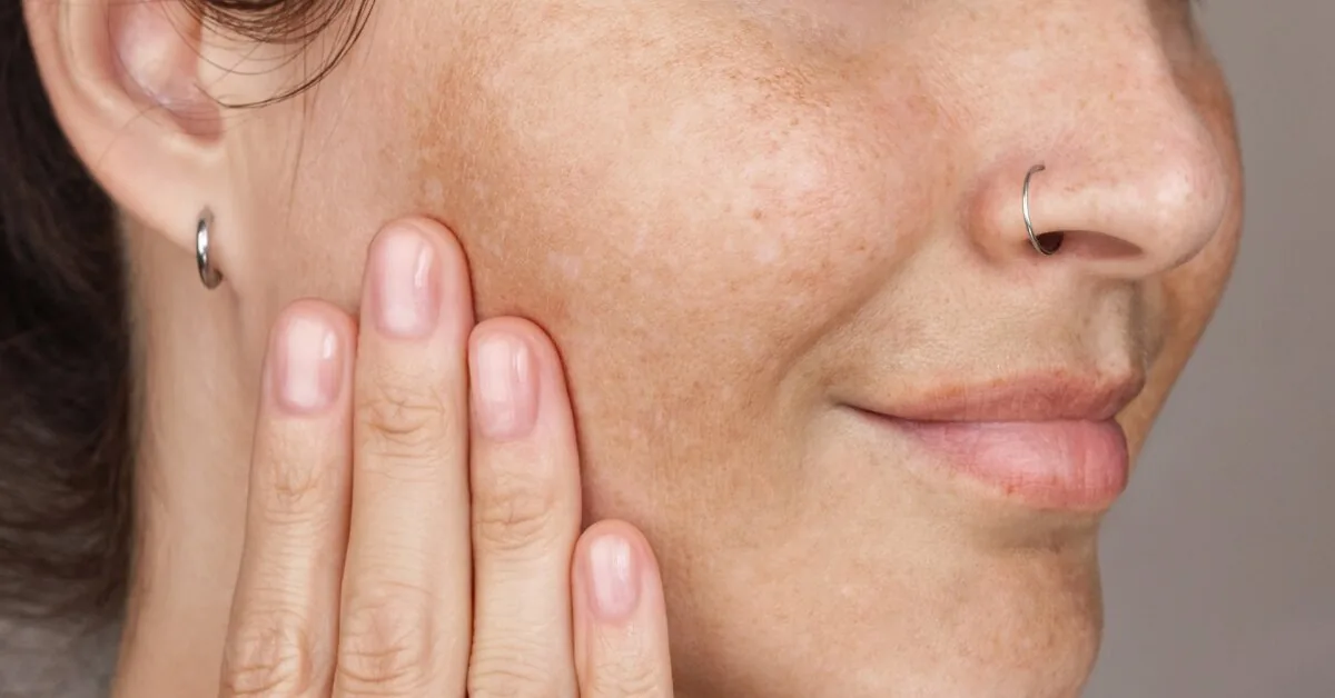 Summer left marks on the skin? They said what will help fight pigmentation spots