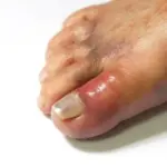 When the weather cools down, gout can remind you of itself: the doctor explained what is important to know