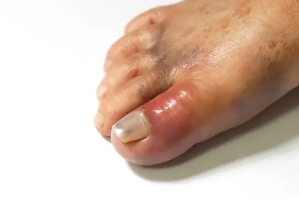 When the weather cools down, gout can remind you of itself: the doctor explained what is important to know