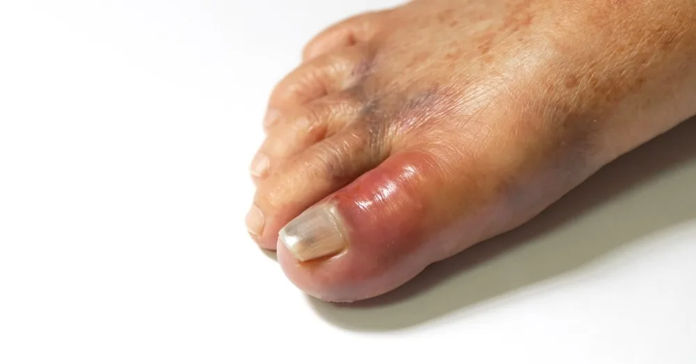 When the weather cools down, gout can remind you of itself: the doctor explained what is important to know