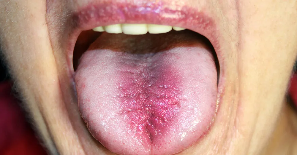 Do you feel like your tongue is burning? The doctor explained what this symptom might mean